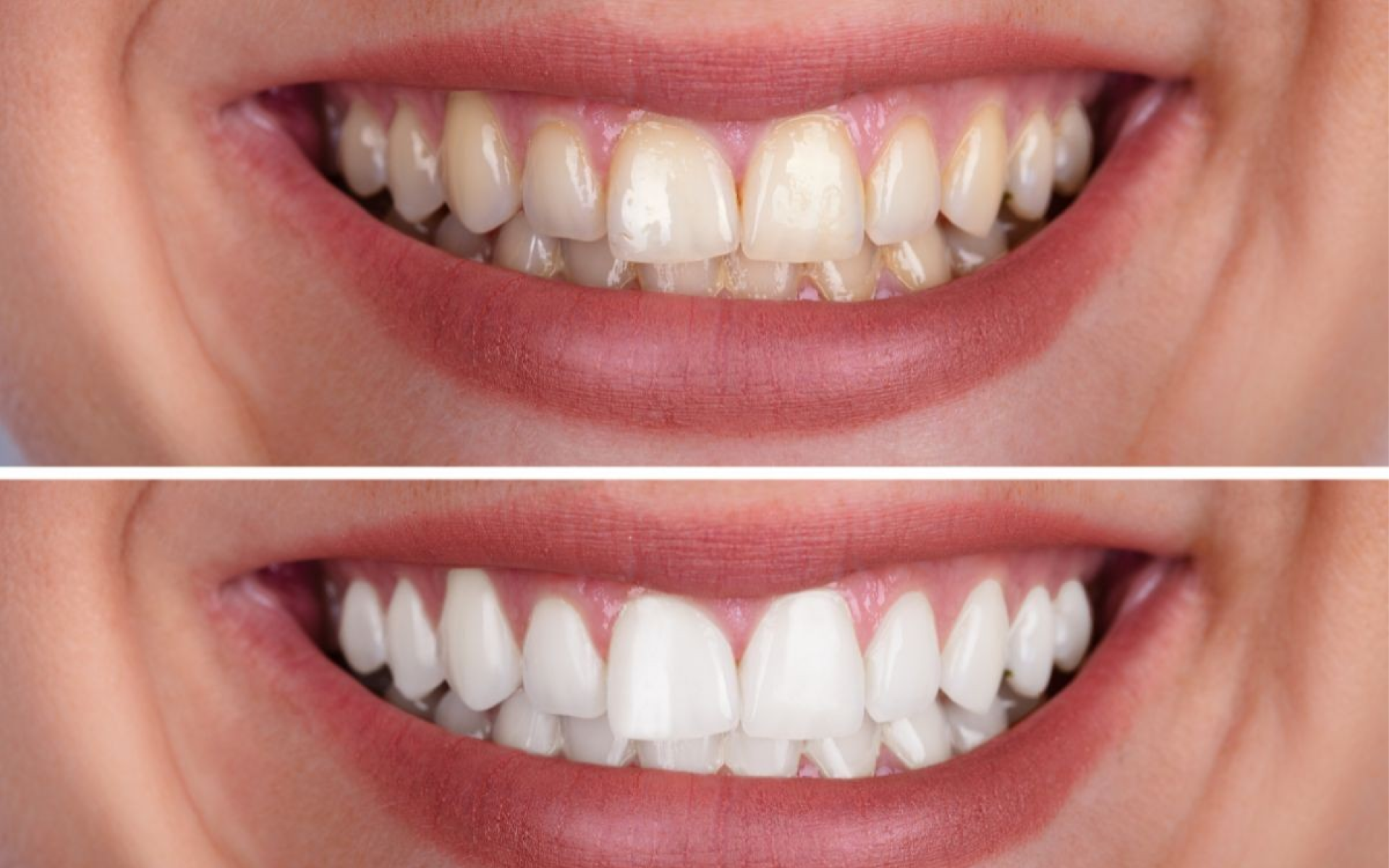 A importância das consultas regulares ao dentista: prevenção é o melhor tratamento