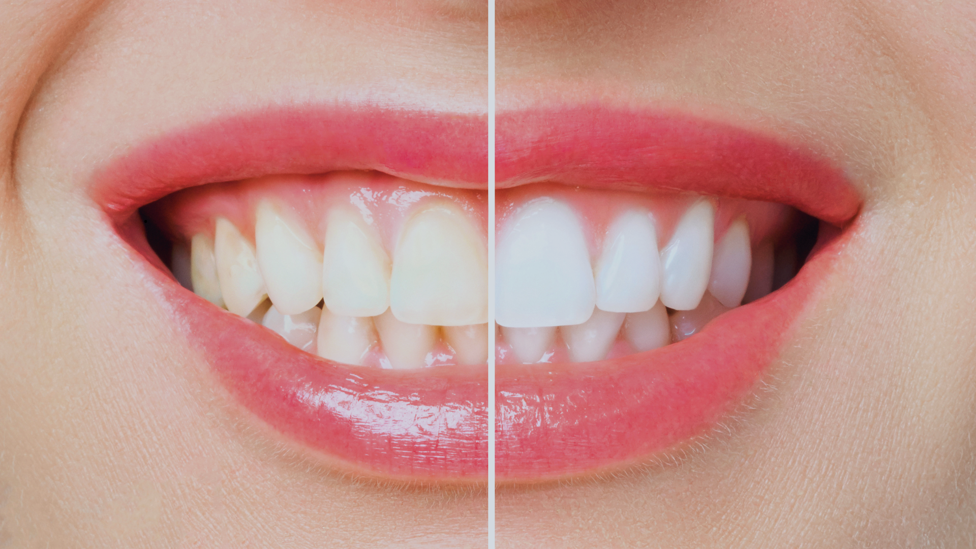 Dentes amarelados? Como recuperar o brilho do seu sorriso com segurança em Ubá