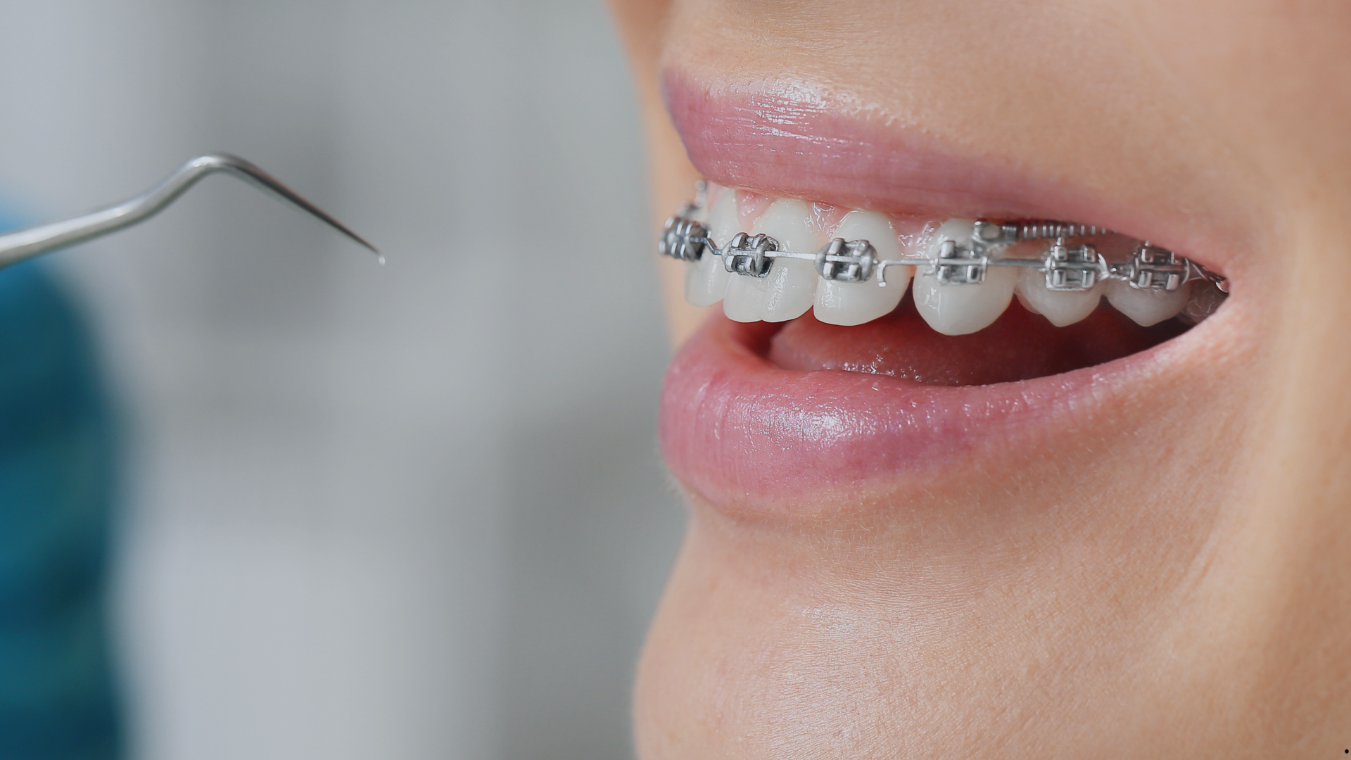 Aparelho Fixo vs Alinhador Invisível: Qual é a melhor escolha para o seu sorriso?
